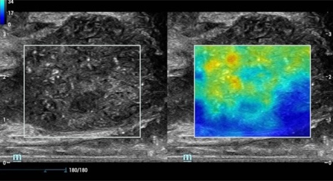 Prostate Elastography